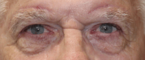 Bilateral Upper Eyelid Blepharoplasty & Bilateral Direct Brow Lift (Post-Operative Week 1) After