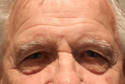 Bilateral Upper Eyelid Blepharoplasty & Bilateral Direct Brow Lift (Post-Operative Week 1) Before