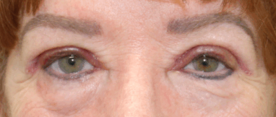 Bilateral Upper Eyelid Blepharoplasty (Post-Operative Week 1) After