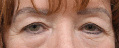 Bilateral Upper Eyelid Blepharoplasty (Post-Operative Week 1) Before