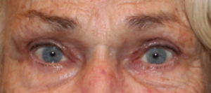 Bilateral Upper Eyelid Blepharoplasty (Post-Operative Week 1) After