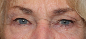 Bilateral Upper Eyelid Blepharoplasty (Post-Operative Week 1) Before