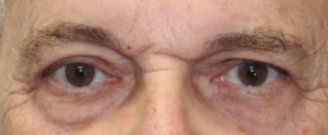 Bilateral Upper Eyelid Blepharoplasty (Post-Operative Month 4) After