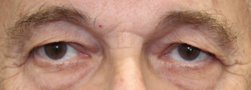 Bilateral Upper Eyelid Blepharoplasty (Post-Operative Month 4) Before