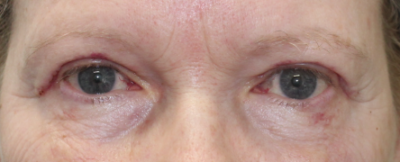 Bilateral Upper Eyelid Blepharoplasty (Post-Operative Week 1) After