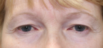 Bilateral Upper Eyelid Blepharoplasty (Post-Operative Week 1) Before