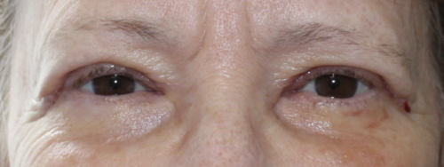 Bilateral Upper Eyelid Blepharoplasty (Post-Operative Week 1) After