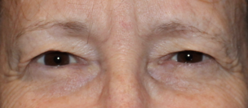 Bilateral Upper Eyelid Blepharoplasty (Post-Operative Week 1) Before