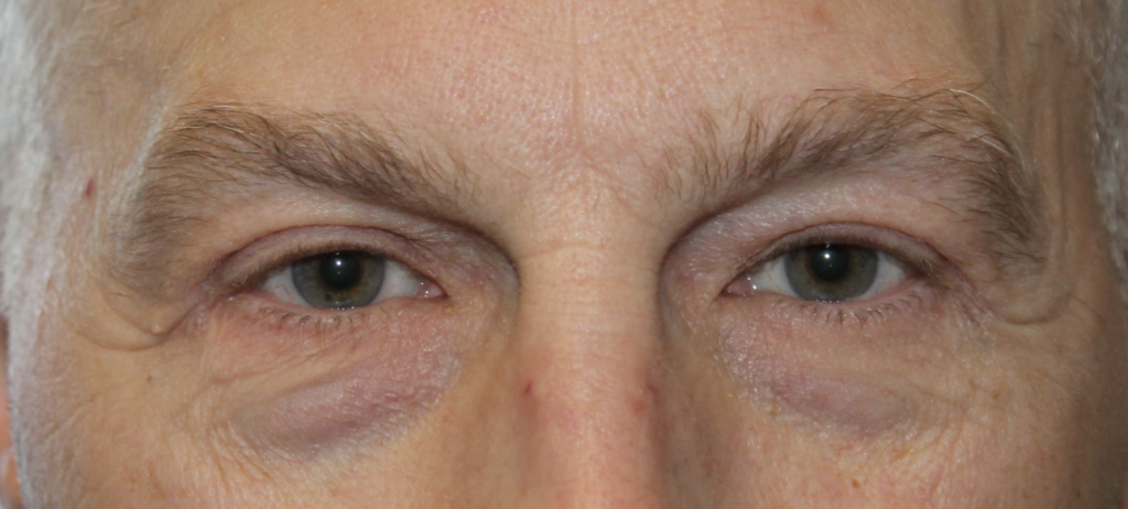 BUL Blepharoplasty After