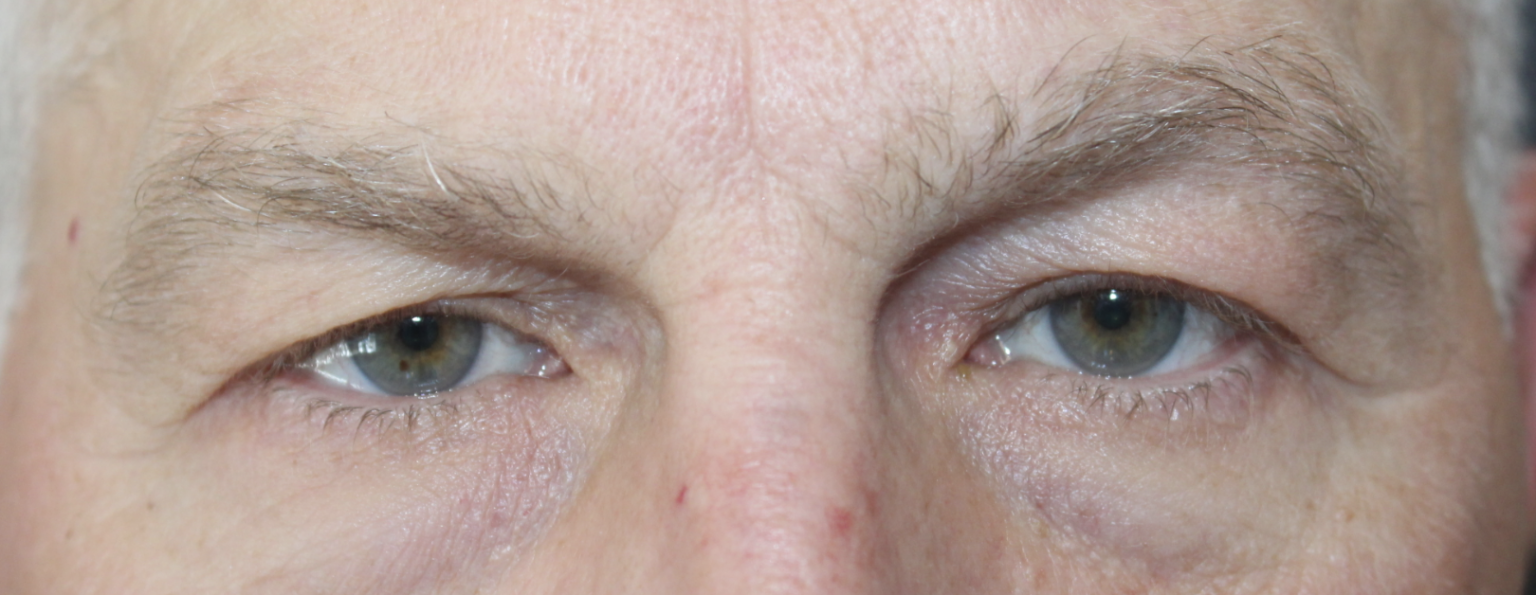 BUL Blepharoplasty Before