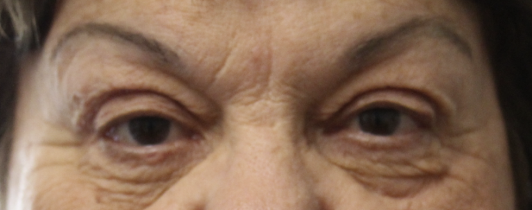 Blepharoplasty (Post-Operative Week 1) After