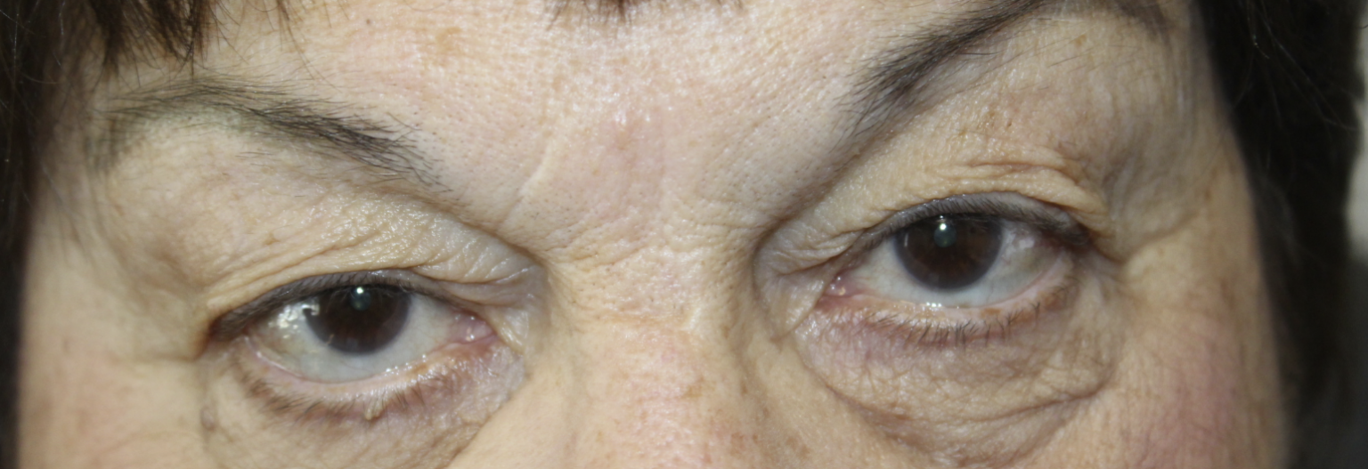 Blepharoplasty (Post-Operative Week 1) Before