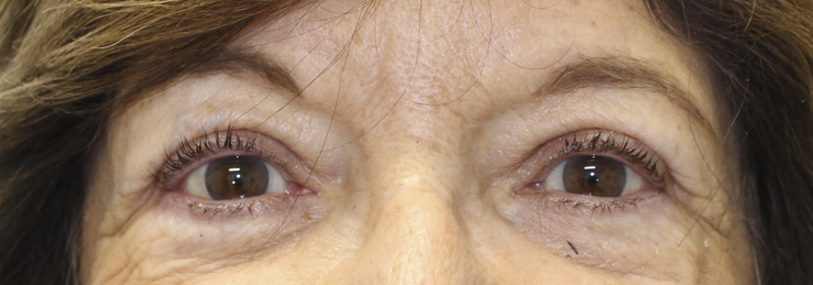 Bilateral Upper Eyelid Blepharoplasty (Post-Operative Week 1) After