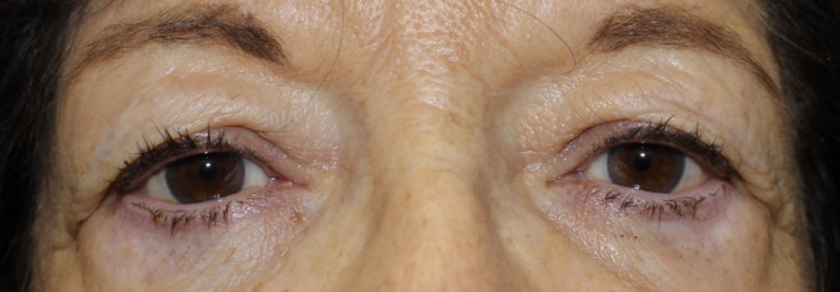 Bilateral Upper Eyelid Blepharoplasty (Post-Operative Week 1) Before