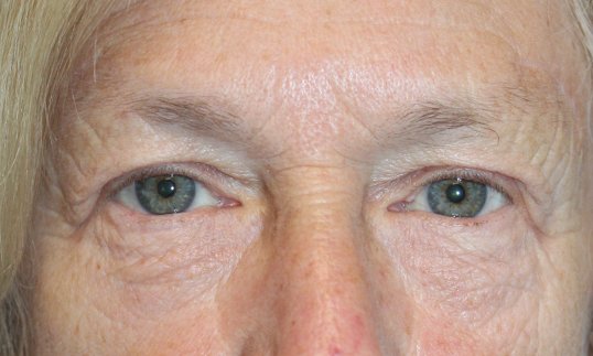 Upper Blepharoplasty and Brow Lift After