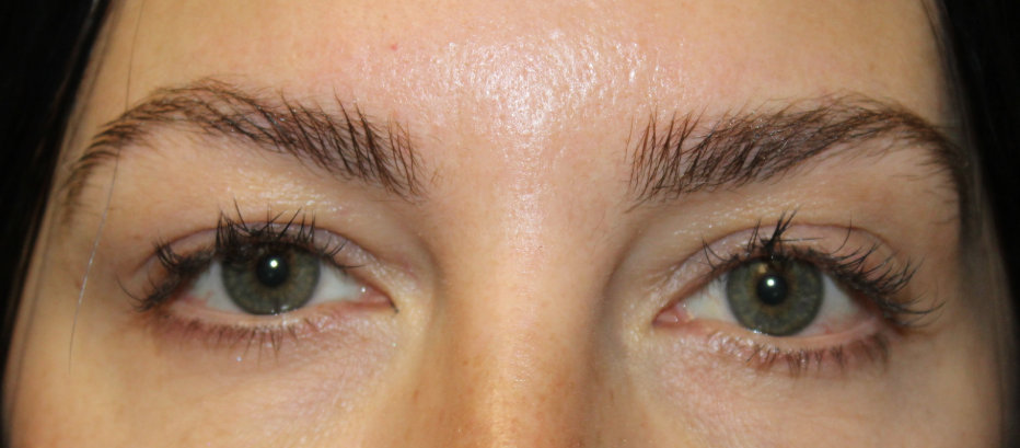 Right Upper Eyelid Cosmetic Internal Ptosis Repair (Post-Operative Month 2) Before