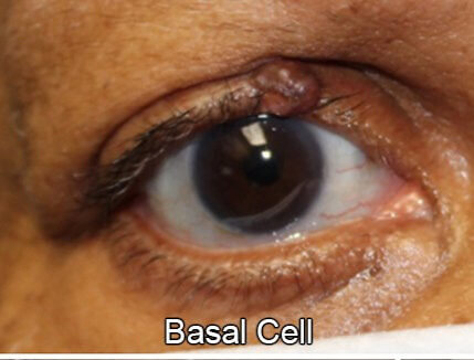 Eyelid Reconstruction After Skin Cancer Basal Cell