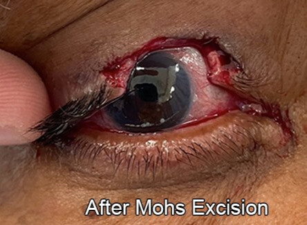 Eyelid Reconstruction After Skin Cancer After Mohs Excision