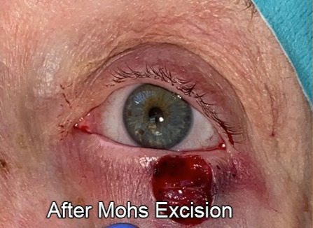 Eyelid Reconstruction After Skin Cancer After Mohs Excision
