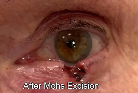 Eyelid Reconstruction After Skin Cancer After Mohs Excision