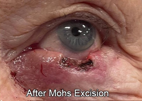 Eyelid Reconstruction After Skin Cancer After Mohs Excision