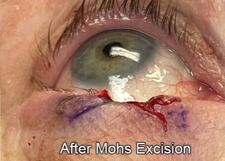 Eyelid Reconstruction After Skin Cancer After Mohs Excision