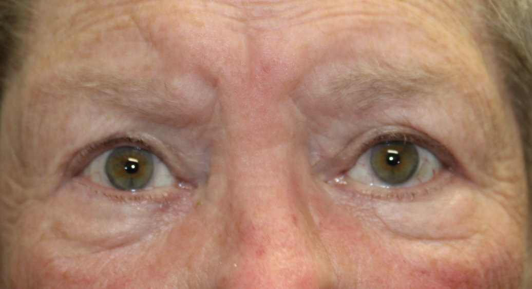 Bilateral Upper Eyelid External Ptosis Repair (Post-Operative Week 1) After