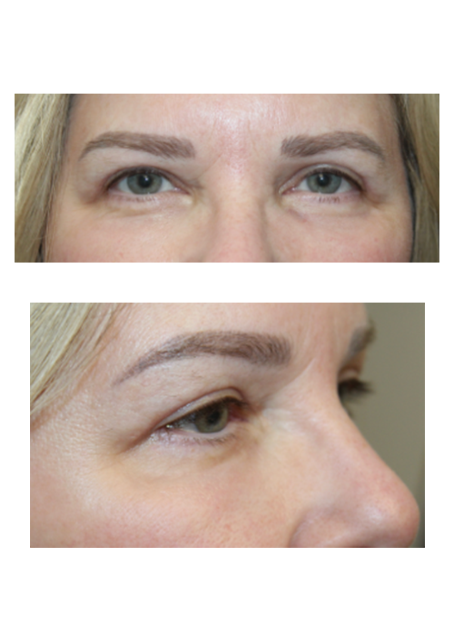 2 Months Following Upper and Lower Blepharoplasty With TCA Peel After