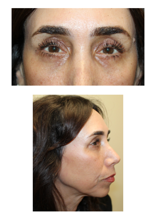2 Months Following Upper and Lower Blepharoplasty With Full Face CO2 Laser Resurfacing After