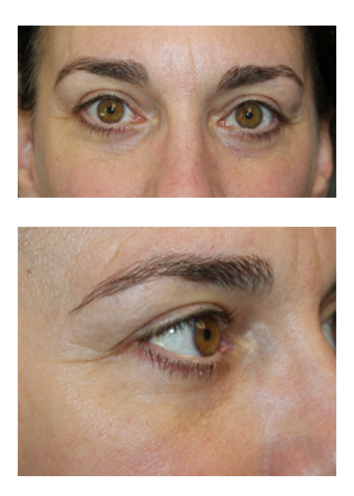 1 Week and 2 Months Following a Lower Eyelid Blepharoplasty With Skin Pinch, Canthopexy, and TCA Peel. 2 Months After