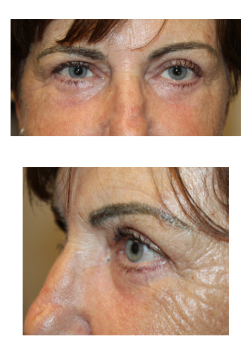 2 Months Following Upper and Lower Blepharoplasty With Tca Peel After