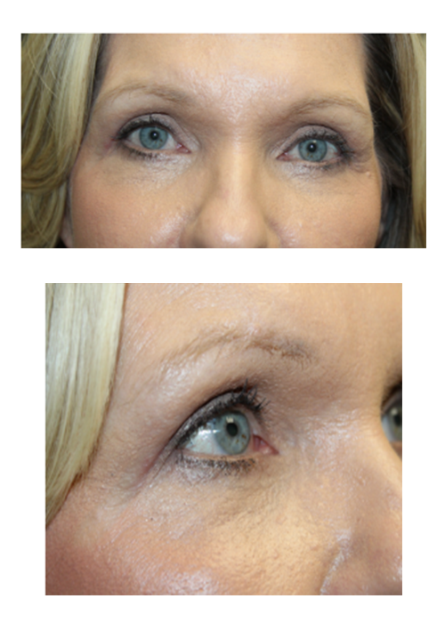 Upper and Lower Blepharoplasty With Skin Pinch, TCA Peel, and Canthopexy After