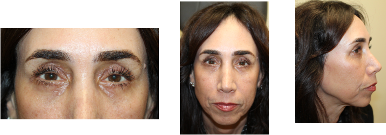 2 Months Following Upper and Lower Blepharoplasty With Full Face CO2 Laser Resurfacing After