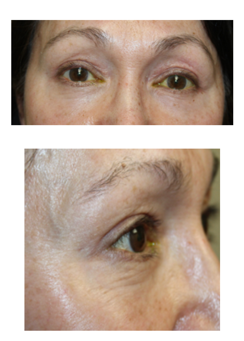 2 Months Following an Upper and Lower Blepharoplasty After