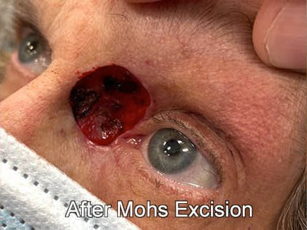 Eyelid Reconstruction After Skin Cancer After Surgery