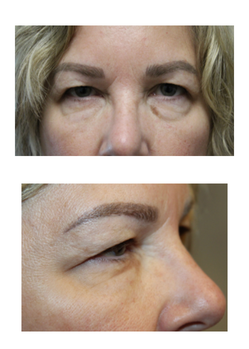 2 Months Following Upper and Lower Blepharoplasty With TCA Peel Before