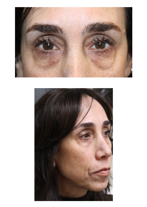 2 Months Following Upper and Lower Blepharoplasty With Full Face CO2 Laser Resurfacing Before