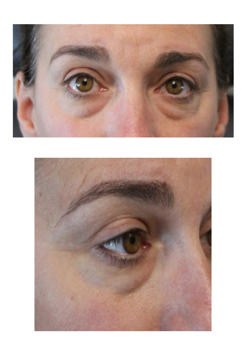 1 Week and 2 Months Following a Lower Eyelid Blepharoplasty With Skin Pinch, Canthopexy, and TCA Peel. Before