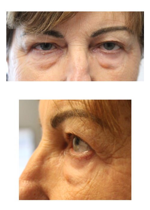 2 Months Following Upper and Lower Blepharoplasty With Tca Peel Before