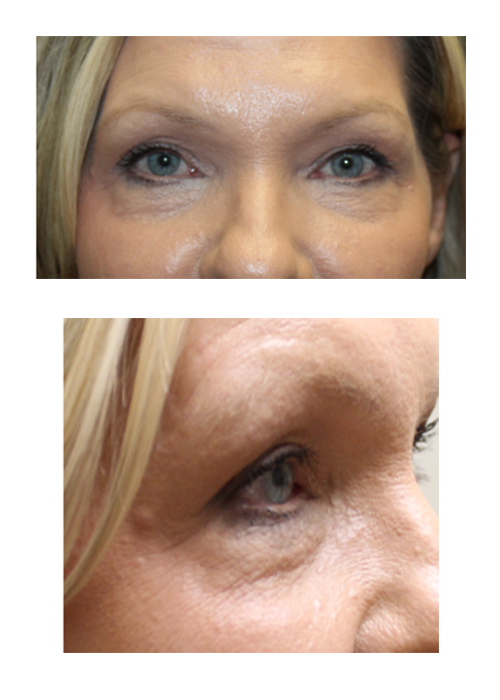 Upper and Lower Blepharoplasty With Skin Pinch, TCA Peel, and Canthopexy Before