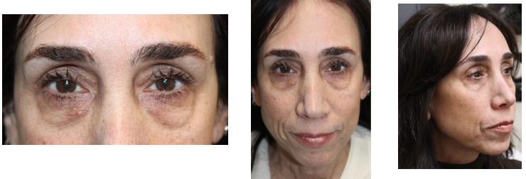 2 Months Following Upper and Lower Blepharoplasty With Full Face CO2 Laser Resurfacing Before