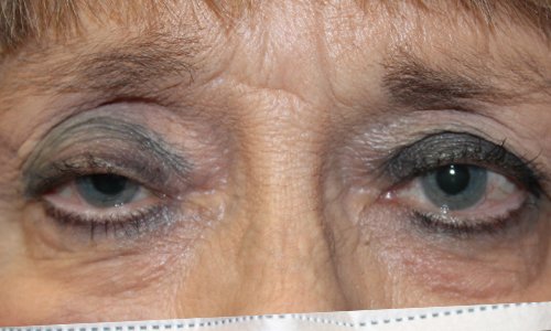 Internal Ptosis Repair of both Eyes Before