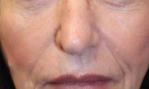 Botox Treatment After