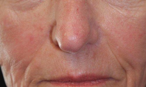 Botox Treatment Before