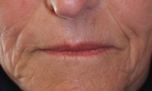 Restylane Treatment Before