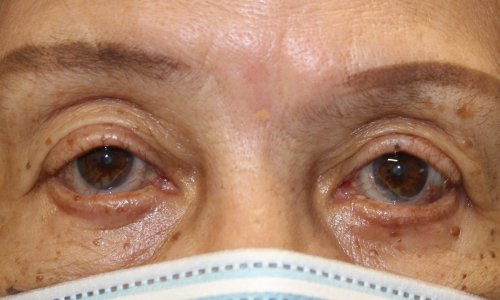 Lower Eyelid Retraction with an Enduragen Graft and Ptosis Repair After