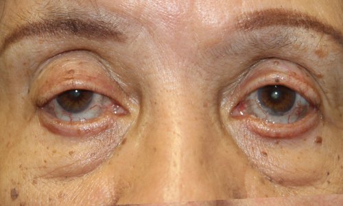 Lower Eyelid Retraction with an Enduragen Graft and Ptosis Repair Before
