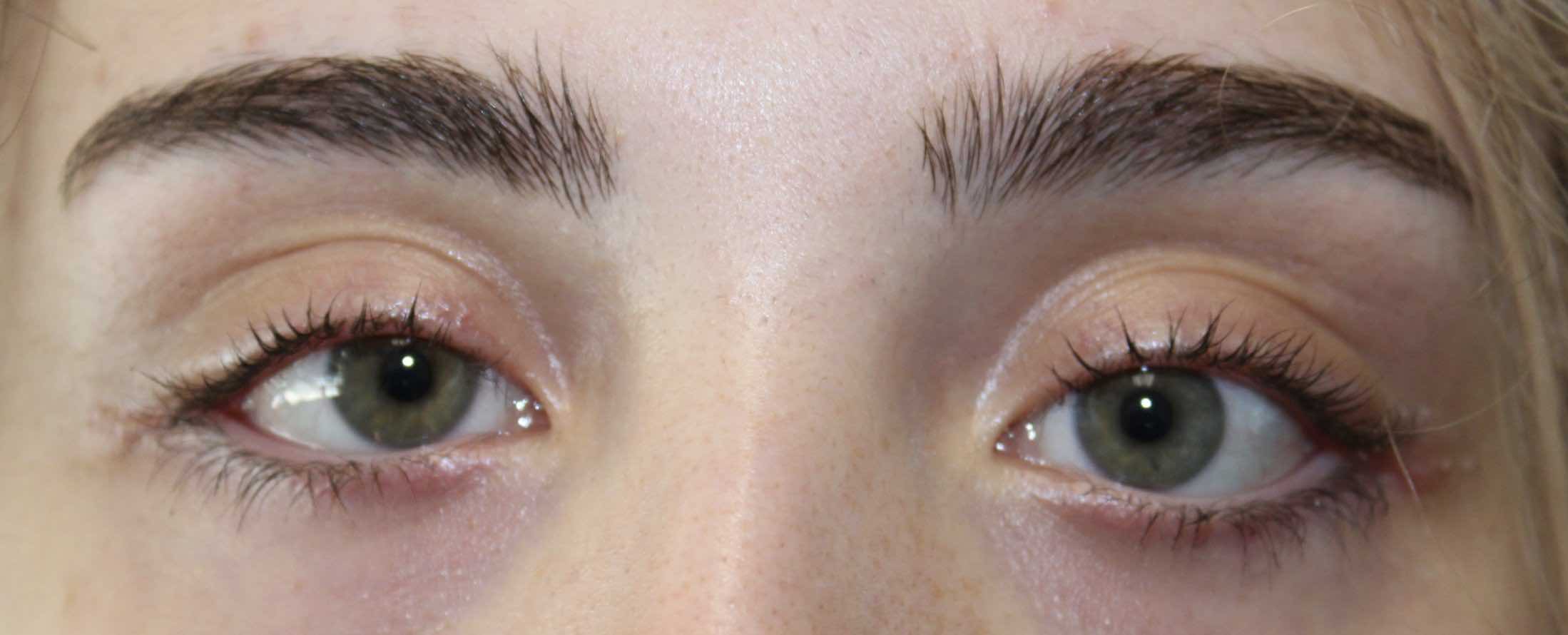 Ectropion Repair & Mini-Facelift After