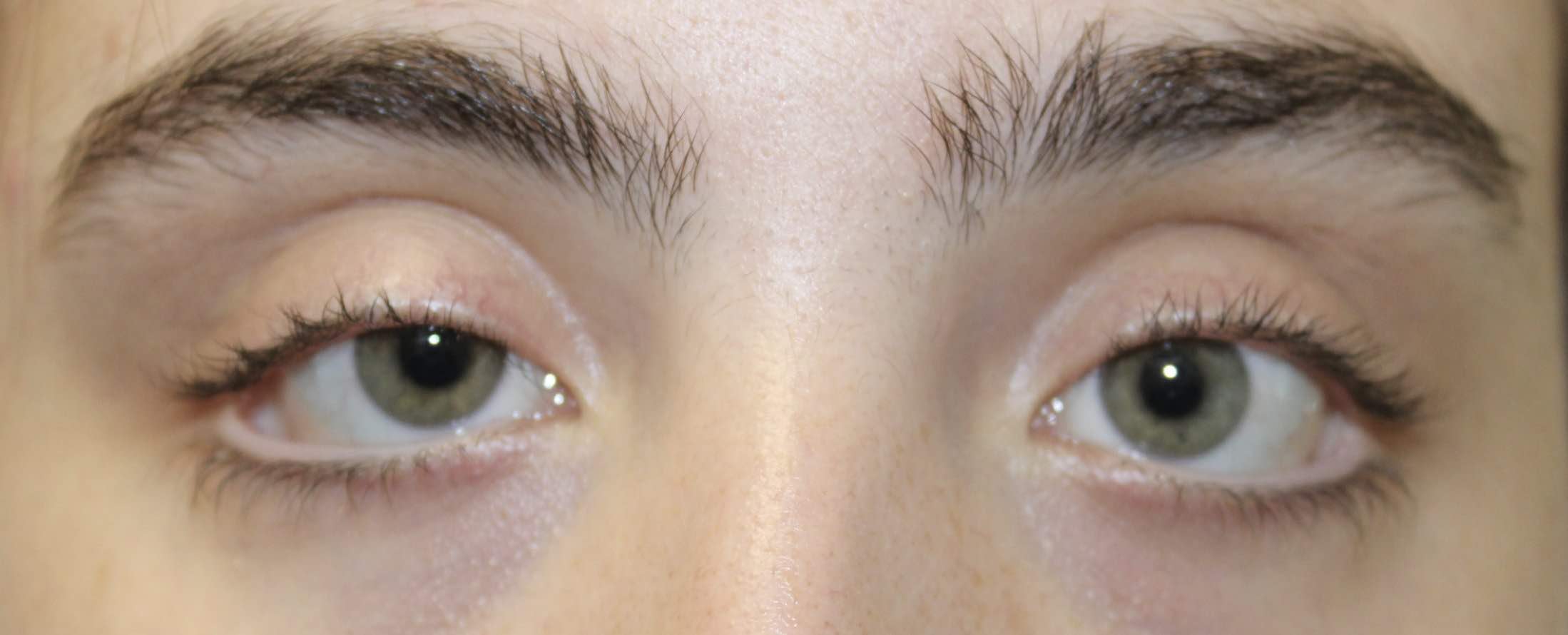 Ectropion Repair & Mini-Facelift Before