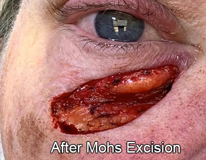 Eyelid Reconstruction After Skin Cancer After Mohs Excision